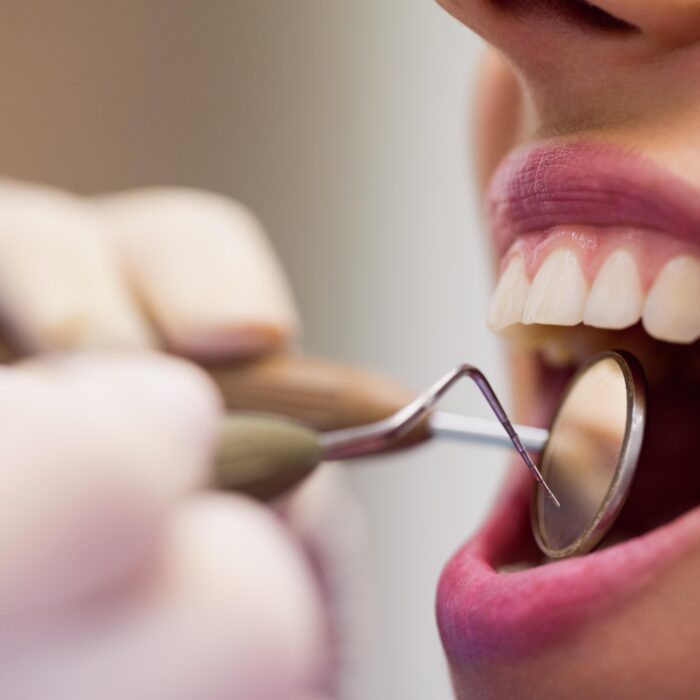Implantes Dentários