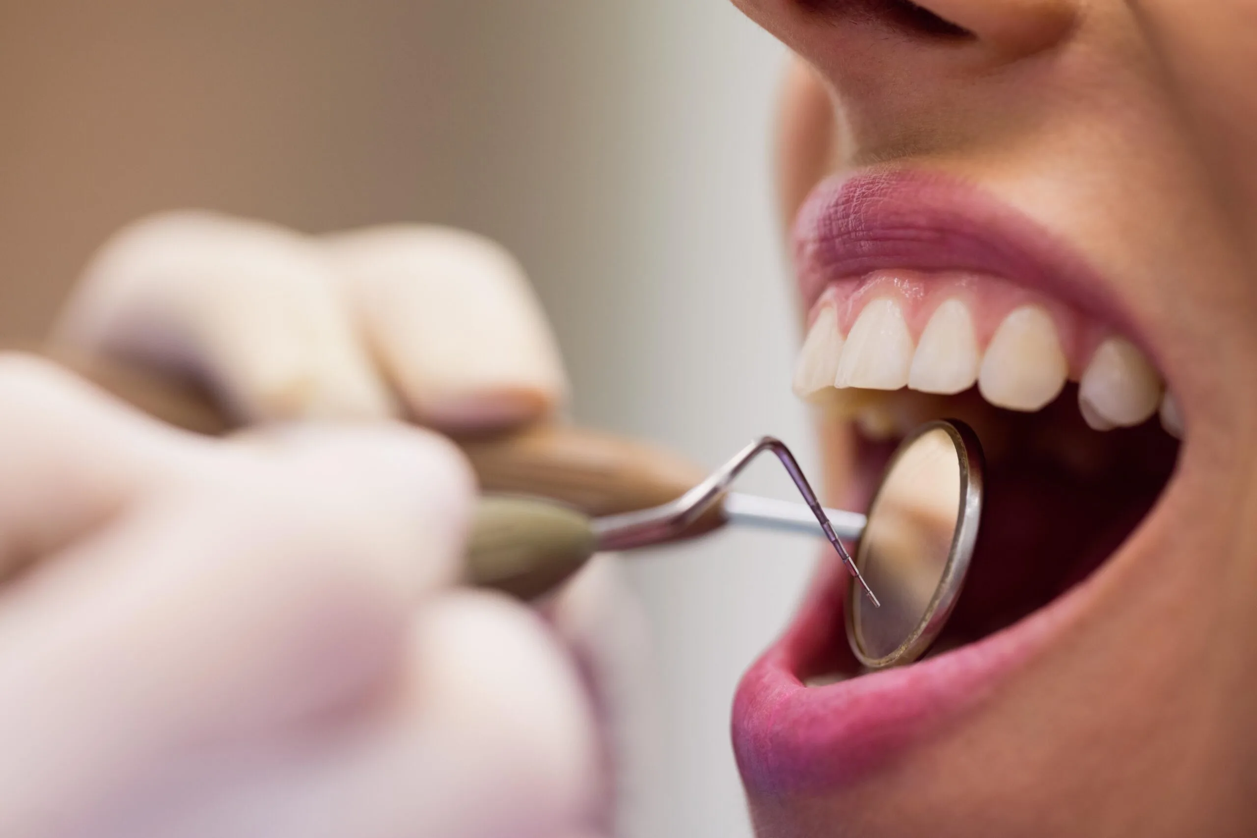 Implantes Dentários